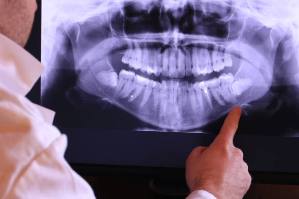 Best Emergency Wisdom Teeth Removal in Centralia, MO